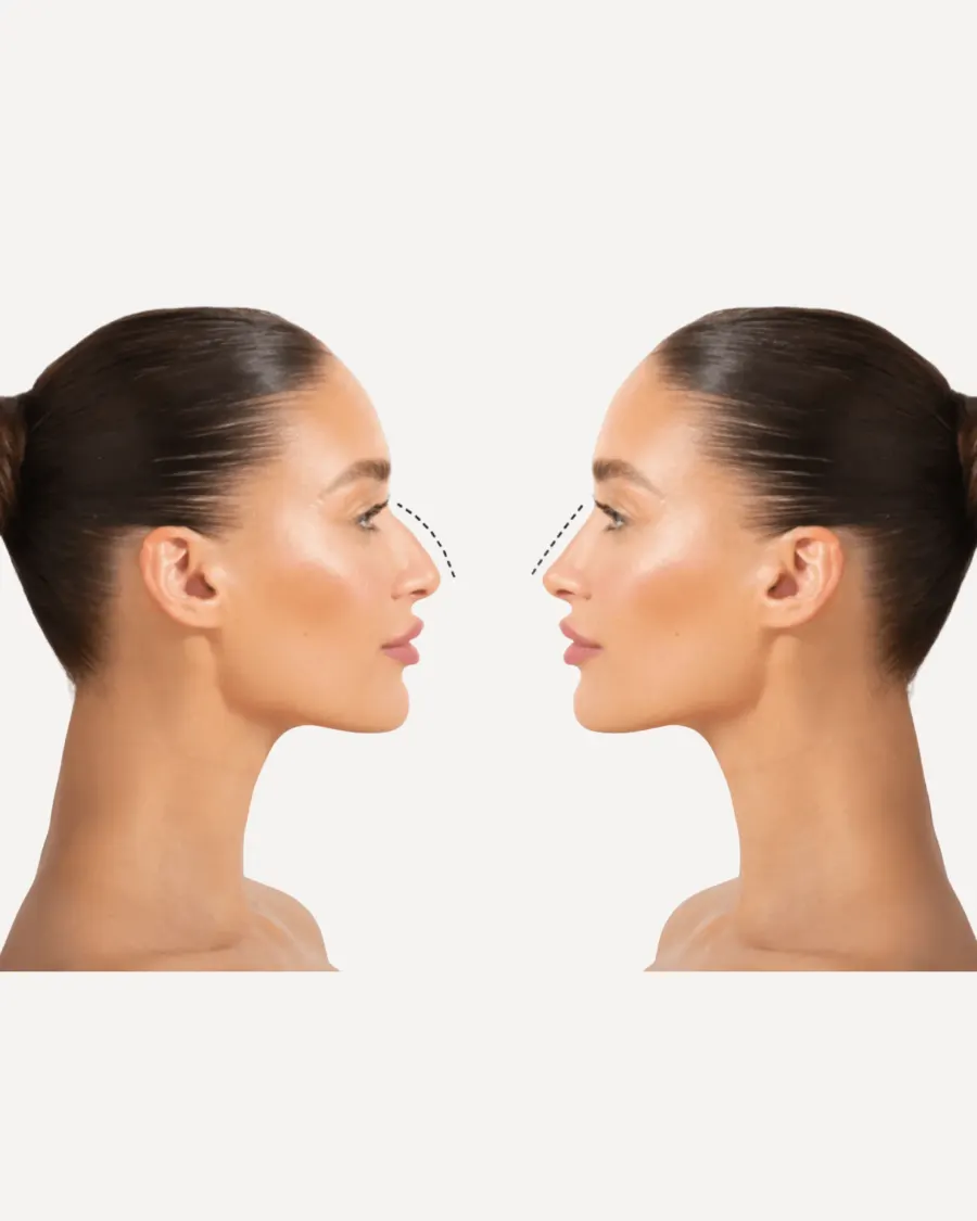 Advanced Nose Reshaping Without Surgery at Cinch Clinics